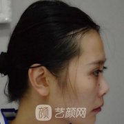 广州艺美整形医院价格表|专家隆鼻案例2021版发布