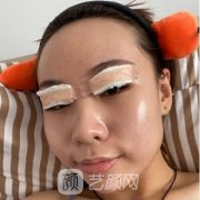 河北医科大学第二医院整形科双眼皮照分享