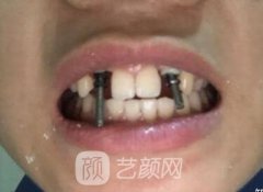 杭州亮贝美口腔医院怎么样？|种植牙案例|价格表上线！
