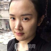 潍坊华美整形医院磨骨咋样？案例口碑一览