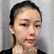 宿州天使整形美容医院价格表|双眼皮案例展示