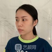 日照市人民医院整形科价格表|双眼皮案例图分享