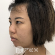 淮南华美整形美容医院价格表2021|附专家双眼皮案例图