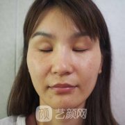 北京艺美医疗美容诊所价格表2021|双眼皮案例一览