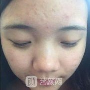 滁州市第一人民医院整形科去疤痕咋样？案例全新反馈