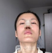 蚌埠市第二人民医院整形外科隆鼻案例|价格表