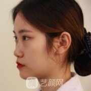 上海整容膨体耳软骨图片，真实案例果片