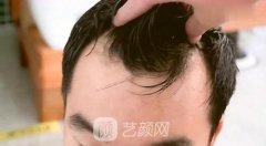 南宁贞韩微创微创植发技术 防脱、固发、生发、植发均可见果