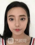 上海九院柴岗半面短小案例：术后面部对称，自卑变自信！