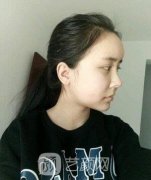 上海九院柴岗下颌角案例，多方面展示技术水平、手术风格！