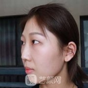 咸阳华尔整形失败修复双眼皮案例：重新收获美丽与自信