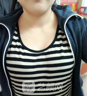 西京医院易成刚缩胸手术案例果图90天的变身之旅