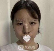 有鼻炎能做隆鼻手术吗？有鼻炎也是能做隆鼻手术的