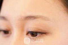 什么是眉毛提升手术？可以改良眉毛下垂吗？