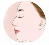 驼峰鼻矫正手术方式，性有吗？
