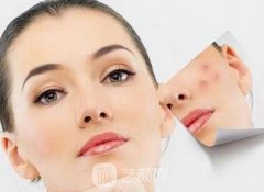 什么是疤痕体质？疤痕体质的人能割双眼皮吗？