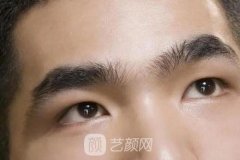 切眉术术前术后注意事项要谨记，几大操作环节得注意