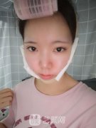 穆雄铮磨骨真实案例，真人下颌角磨骨图片鉴赏