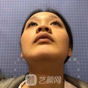 范元涛隆鼻案例图片，术后60天鼻子变化大！