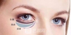 眼袋抽脂是怎么做的图片，眼袋抽脂后会反弹吗？