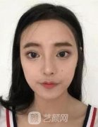西京医院张曦颧骨整形案例，拥有小v脸真好
