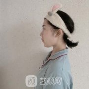 北京禾美嘉贺天遥面部吸脂案例，嘟嘟脸瘦下来真好看