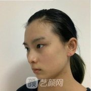 柴云眼修复案例，原来我可以这么好看