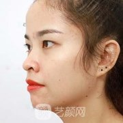 济宁人民医院刘郭双眼皮案例，美丽与气质的分水岭