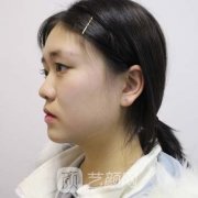 合肥褚燕军双眼皮案例，冰冷的形象变得温柔似水