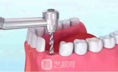 西泰克植体外形设计有什么亮点？西泰克植体使用寿命多久？