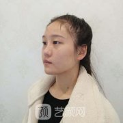曹卫华双眼皮案例，让美丽变得更加简单