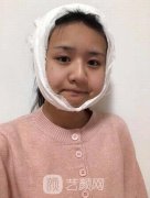 吉玟锡磨骨案例，磨骨整形重塑年轻容颜，美极了