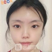 菏泽华美做双眼皮案例，实力果然出色，变美好多