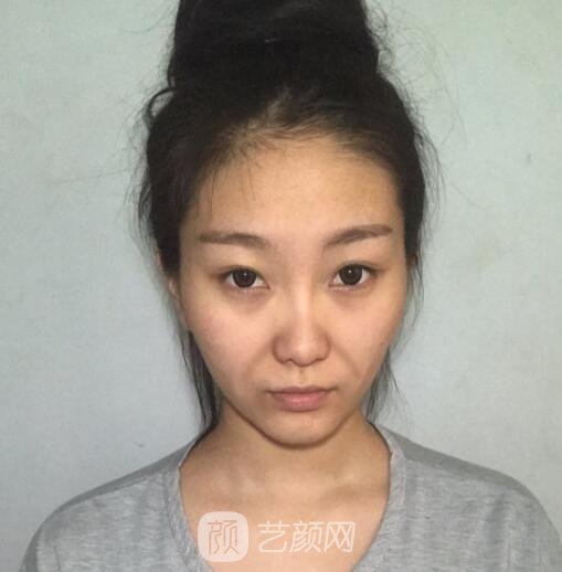 上海九院林晓曦面部提升好不好？技术怎么样？面部提升案例