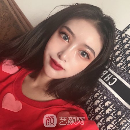 林晓曦医生做眼综合自然吗?网友90天恢复细节分享