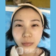 谢宏彬拉皮野生案例，术