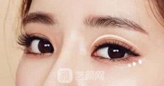北京韩式双眼皮手术价格
