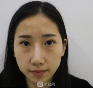 开外眼角前后对比照片案