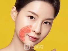 自体脂肪填充法令纹效果