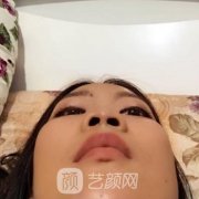 刘光晶鼻子案例，术后鼻