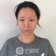 美杜莎综合美眼恢复图|美