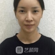 宽鼻矫正恢复过程图分享