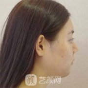 面部吸脂效果图片分享，