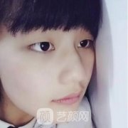 成都刘辅容双眼皮修复案