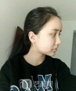 短下巴整形术后惊人效果