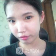 鼻翼缩小前后对比照片|鼻