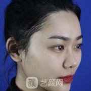 蒜头鼻整形前后对比图片