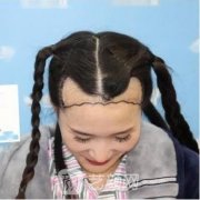 毛发移植效果图分享：毛