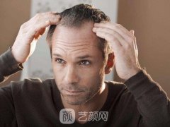 青年男性脱发怎么办？摆