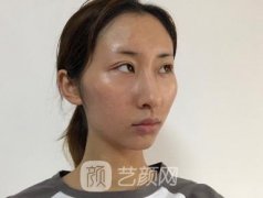 磨颧骨前后对比图，磨颧